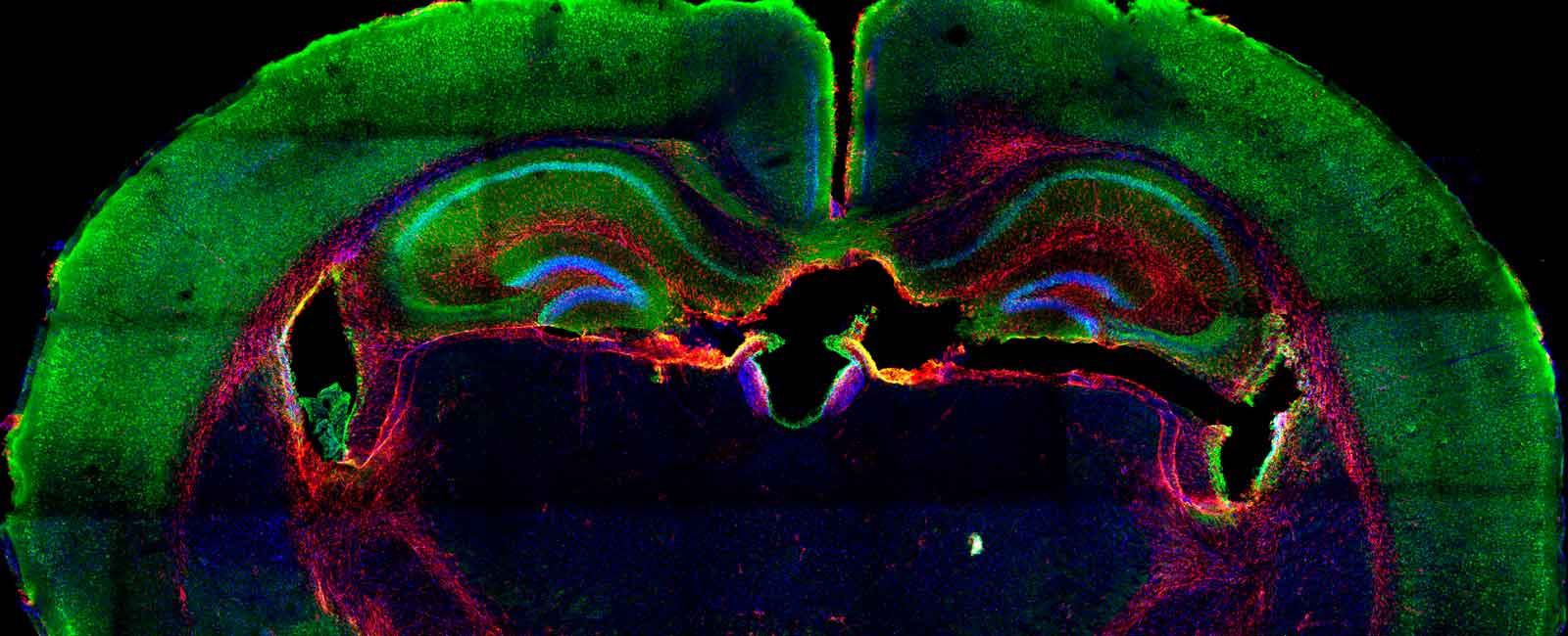 glioma_NOTICIA_1600X650