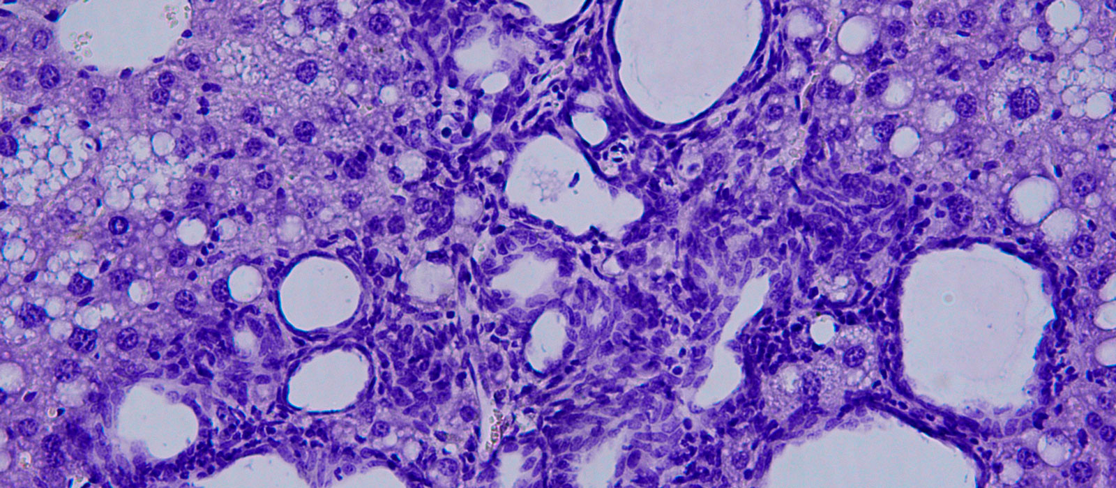 Colangiocarcinoma visto al microscopio. CNIC
